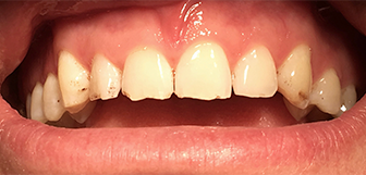 Worn and cracked teeth before dental treatment